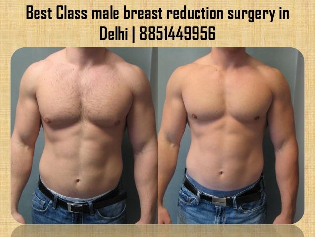 surgical breast reduction Surgical breast reduction